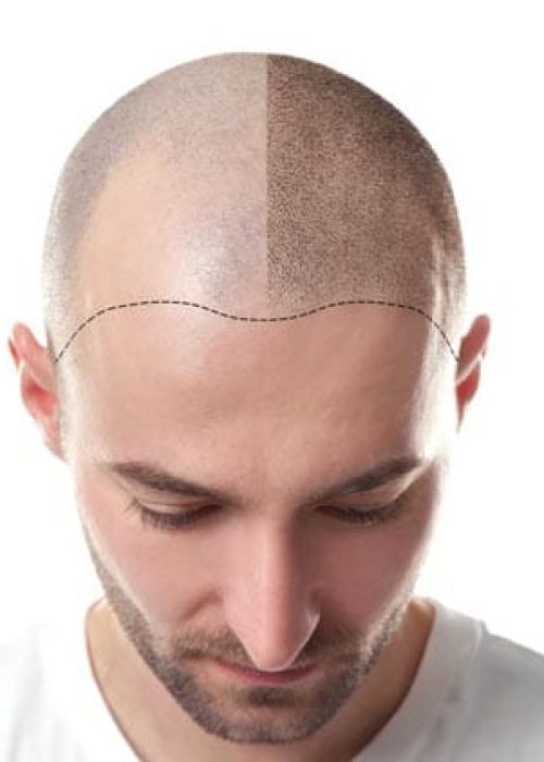 Transplantacija kose – Hair and Skin Clinic Beograd